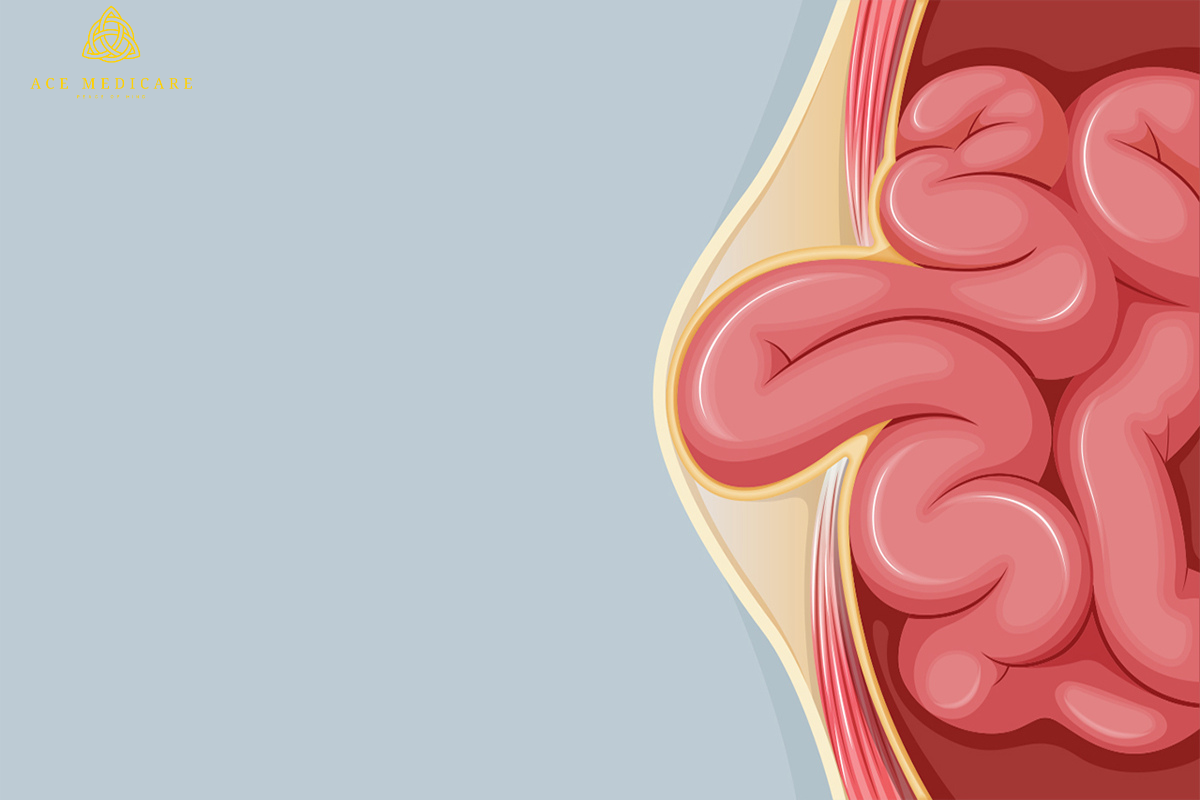 Understanding Hernia: Causes, Symptoms, and Treatment Options